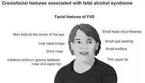 Pin By Lorelei On Smarty Pants Fetal Alcohol Syndrome Fetal Alcohol Foetal Alcohol Syndrome