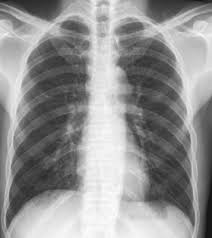 Oct 13, 2020 · l'emphysème pulmonaire existe sous différentes formes. Manifestations Pulmonaires Au Cours De L Infection Par Le Vih Demarche Diagnostique Sciencedirect