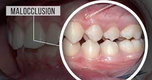 My Dental Crown Just Cracked What Do I Do