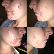 When to sleep on your back with azelaic acid? B A One Month S Difference Of Minimising My Routine And Using Finacea Azelaic Acid Skincareaddiction