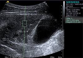 Evaluation Of Schistosomiasis Mansoni Morbidity By Hepatic And Splenic Elastography Ultrasound In Medicine And Biology
