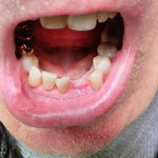 We did not find results for: Preventing Alveolar Osteitis A Dry Socket After Losing A Tooth Probaway Life Hacks