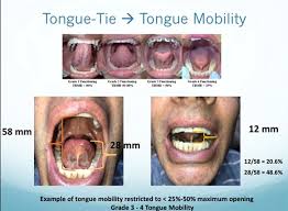 The fascia or connective tissue bunches up and forms the appearance of a string or frenum, and often there is a good bit of tension as well. Tongue Tie And Lip Tie In Adults Arlington Smile Center Lupita M Roca Dds Arlington Va