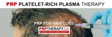 Prp hair loss treatment is ideal for treating male pattern hair loss, in addition to female pattern hair loss or other facial hair loss (i.e. Platelet Rich Plasma Prp Treatment In Toronto And Richmond Hill