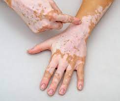 La vitiligine è una malattia che colpisce l'epidermide. Vitiligine