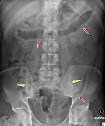 Image result for Intestinal Enteropathy
