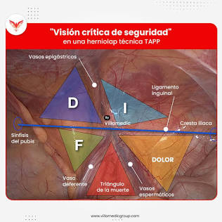 Anatomía De Seguridad: Triángulo Del Dolor Y De La Muerte En La Región Inguinal, Generada Por Ia