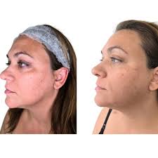FACTORFIVE RDS Peel..... wow! No pain, No Downtime and Amazing reaults!!!!  Book yours today so you can start 2025 looking like your best self!  @factorfiveskin @theskingames #skincare #melbournefacial #facial  #melbournefl