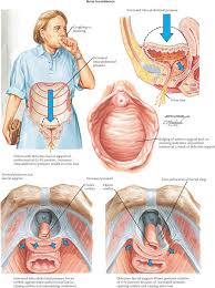Image result for Stress Incontinence