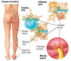 Pain on the outside of your hip or lateral hip pain, is a common problem in females>males, especially from the. Sciatica Harvard Health