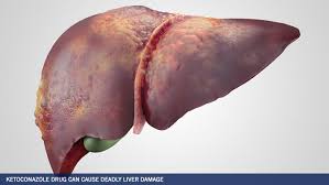 Applied to the skin it is used for fungal skin infections such as tinea, cutaneous candidiasis, pityriasis versicolor, dandruff, and seborrheic dermatitis. Ketoconazole Can Cause Deadly Liver Damage Parker Waichman Llp