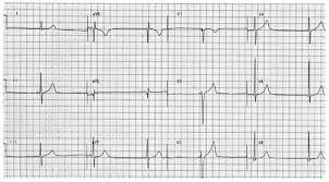 Sir i please tell me, is this any problem. Ecg Review Abnormal Ecg In A 35 Year Old Man 2006 01 15 Ahc Media Continuing Medical Education Publishing