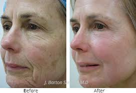 It is one of the best skin lightening peels as it helps in the removal of acne scars, blackheads. Chemical Peel Laser Skin Treatments J Barton Sterling Md