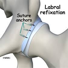 Image result for Hip Labral Tear