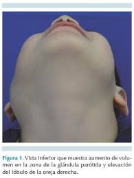 Image result for Sialoadenitis