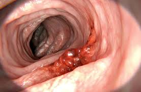 Check spelling or type a new query. What You Can Do To Catch Colon Cancer Early Health Essentials From Cleveland Clinic