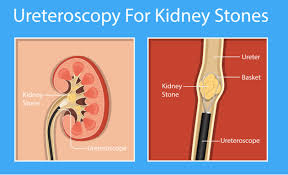 What To Expect When You Need A Kidney Stone Surgery Medanta