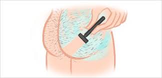 An ingrown hair on your bum can be painful, but it usually isn't serious. Butt Crack Hair Removal And Tips To Get Rid Of It For Women Men Brighter Press