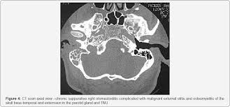 Image result for Necrotizing Otitis Externa