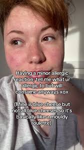 Blue Cheese Allergy