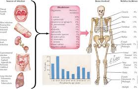 Image result for Osteomyelitis