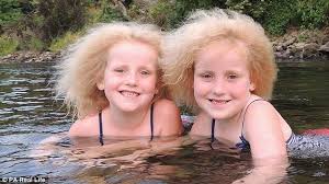 Pin On Uncombable Hair Syndrome