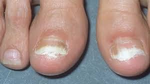 Image result for Beau lines feet