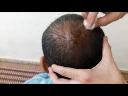 افضل طريقة لعلاج الصلع والثعلبة والفراغات بين الشعر والنتائج في وقت قصير باذن الله Youtube Grow Hair Hair Design