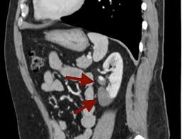Image result for Renal Infarction