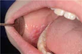 Image result for lichen planus on tongue)