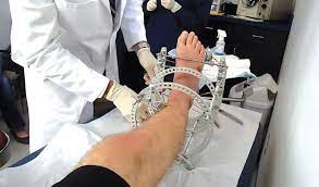 Jilbab asyik cipokan sambil cegukan. Sambung Tulang Patah