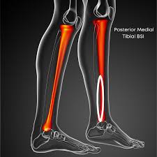 Image result for Tibia Stress Fracture