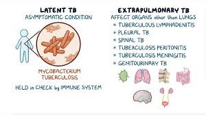 Image result for Extrapulmonary Tuberculosis