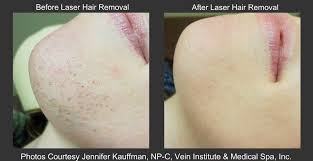 Laser Hair Removal