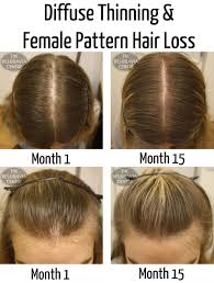 Home Remedies For Hair Loss In Women Find Out More About The Great Product At The Image Link Hair Loss Remedies Women Thining Hair Hair Loss Women Treatment