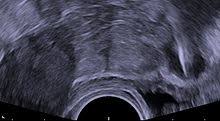 الإثم وغِشيان المحارم؛ ومنه قول. Intrauterine Device Wikipedia