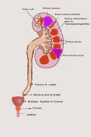 Haematuria Hematuria Edren Org