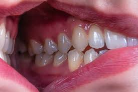 Broken Tooth Emergency Lakewood CO
