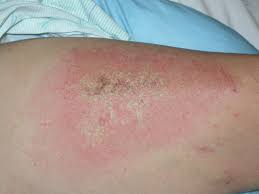 Chemical Burn Care: A Review Of Best Practices