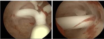 Iud removal is likely to be less uncomfortable than insertion, though cramping can occur here too. Malposition And Displacement Of Intrauterine Devices Diagnosis Management And Prevention