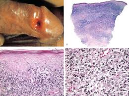 Image result for syphilis ulcer