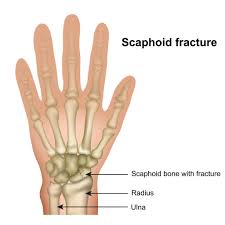 Scaphoid Fracture Symptoms And Treatments Panther Sports Medicine 306 x 256 jpeg 13 кб. scaphoid fracture symptoms and