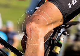 Arthrose Im Knie Ursachen Symptome Und Behandlung Arthrose Des Knie Der Zweiten Stufen