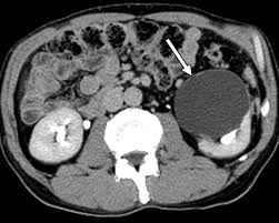 Image result for Helical CT Urogram