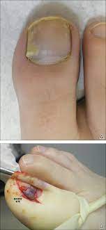 As cancer progresses, more streaks may appear, often with different colors. Subungual Onycholemmal Cyst Of The Toenail Mimicking Subungual Melanoma Mdedge Dermatology