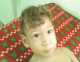 Síndrome Seckel. Reporte de un caso. Seckel syndrome. A case report.