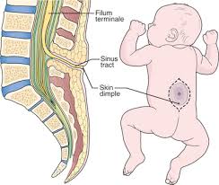 Image result for Spinal Dysraphism
