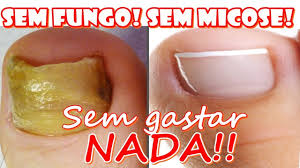 Tratamento para fungos nas unhas: Poderoso Remedio Caseiro Para Matar Fungos Na Unha Sem Gastar Um Centavo Fran Adorno Youtube