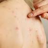 The monkeypox virus is the etiological agent of monkeypox, which can be acquired from an infected animal, such as a squirrel or monkey, through bites, direct contact with its. Https Encrypted Tbn0 Gstatic Com Images Q Tbn And9gcr7m00mxj70qyurvs0htne36aepip9g0 W N0buyhvlvgraio Y Usqp Cau