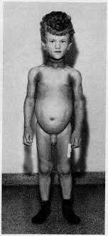 This is mostly evident at birth where the infant will seem to manifest a muscular appearance due to loss of. Https Eje Bioscientifica Com Downloadpdf Journals Eje 72 3 Acta 72 3 007 Pdf